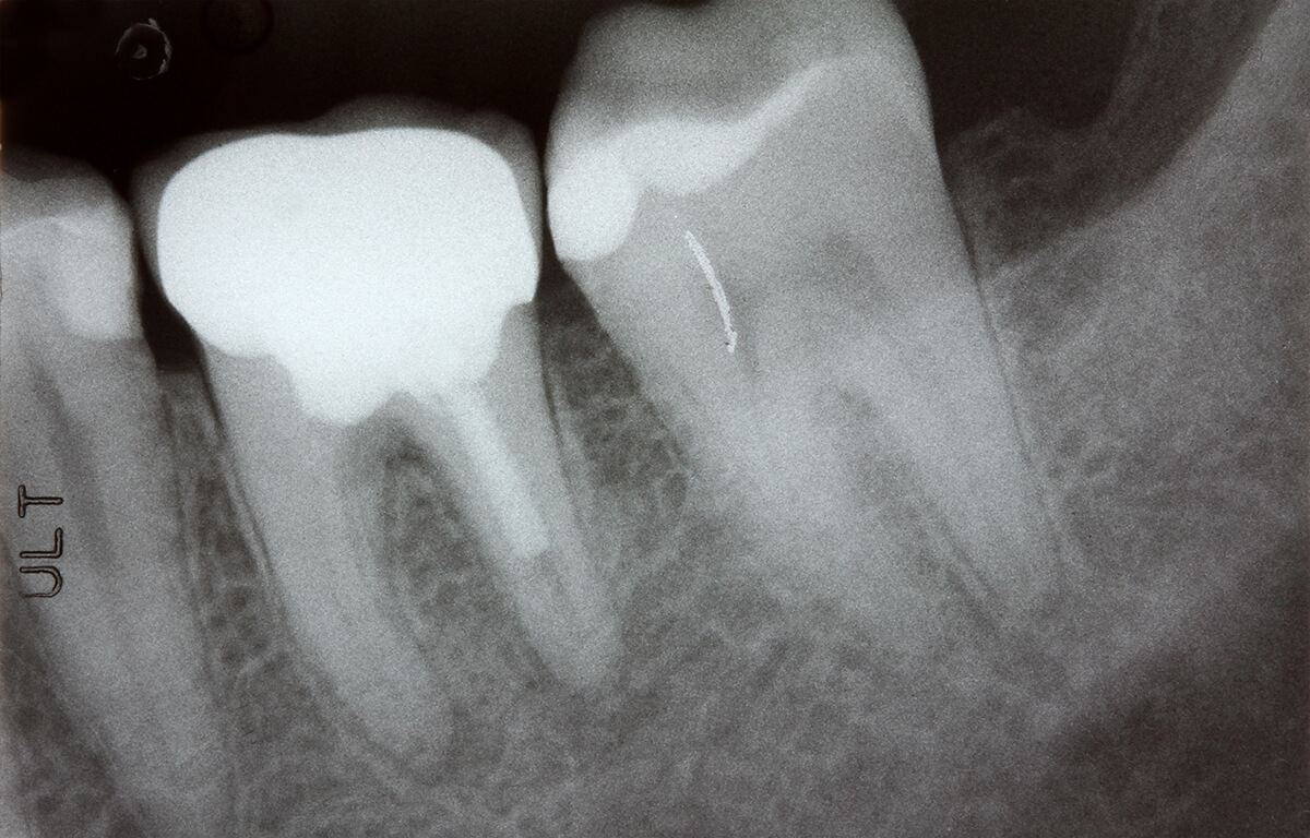 治療を重ねるたびに歯は弱ってしまいます