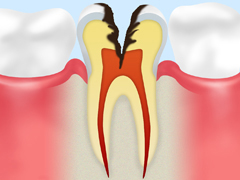 C3神経に達した虫歯